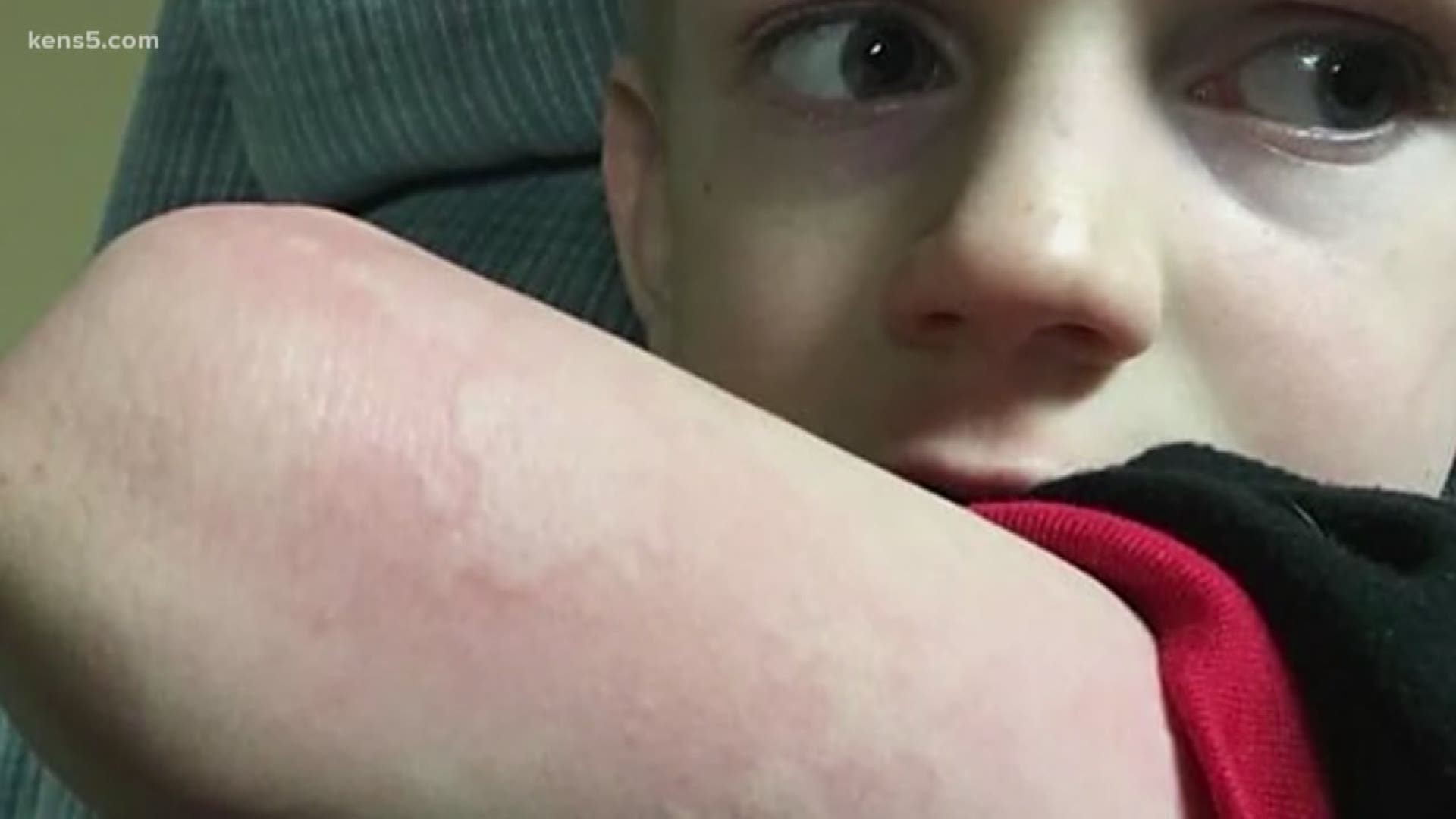 In North Texas, some doctors are seeing children break out in hives shortly before being diagnosed with the flu.