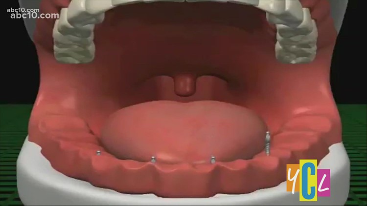 How Mini Dental Implants Work