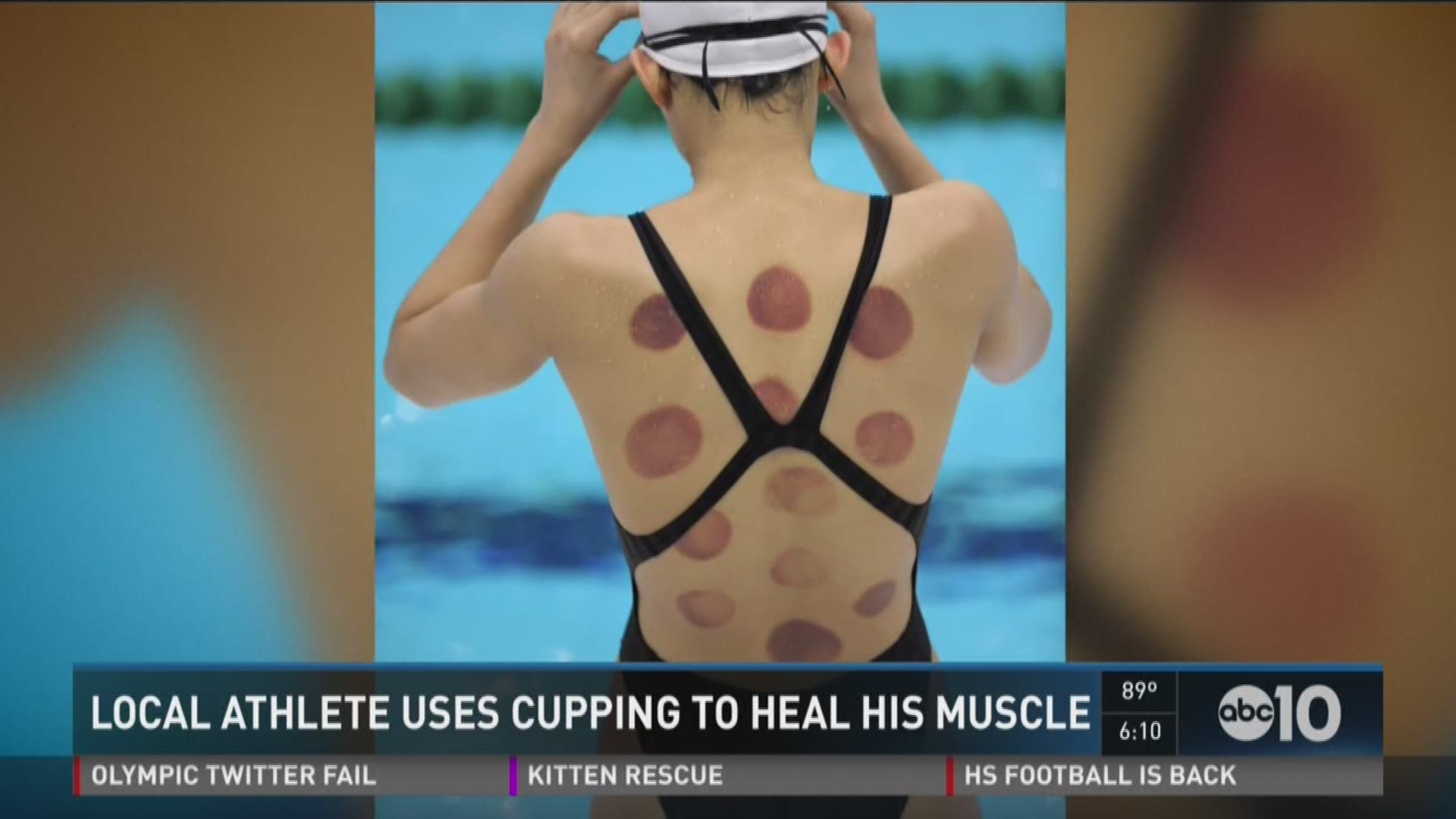If you watched the Olympic Games over the weekend, you may have noticed some of the athletes, including Michael Phelps, had circular bruises on their bodies and it may have freaked out out a little. Aug. 8, 2016