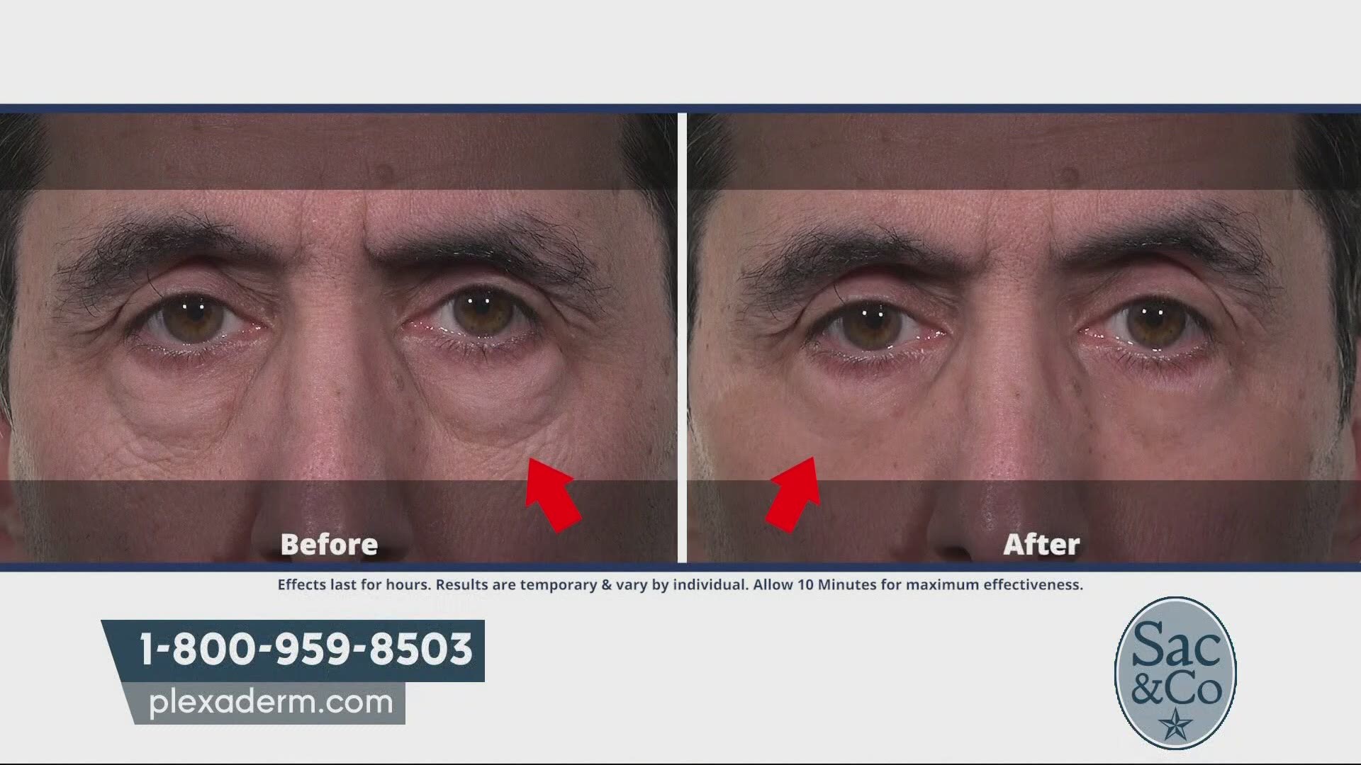 Learn how Plexaderm may be able to reduce under eye bags, dark circles, and wrinkles from a view. The following is a paid segment sponsored by True Earth Health Solutions.