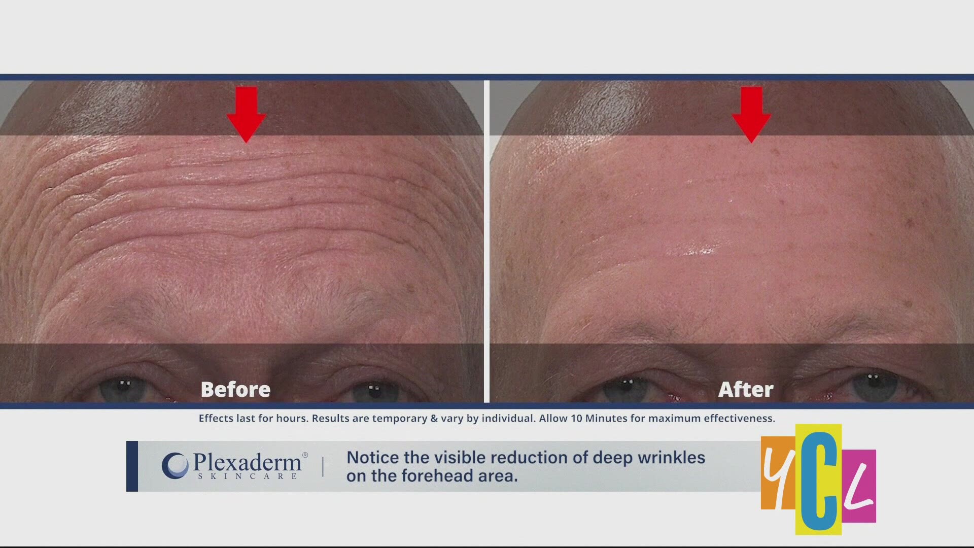 Plexaderm may be able to get rid of those unwanted wrinkles, under eye bags, and dark circles in as little as five minutes. The following is a paid segment.