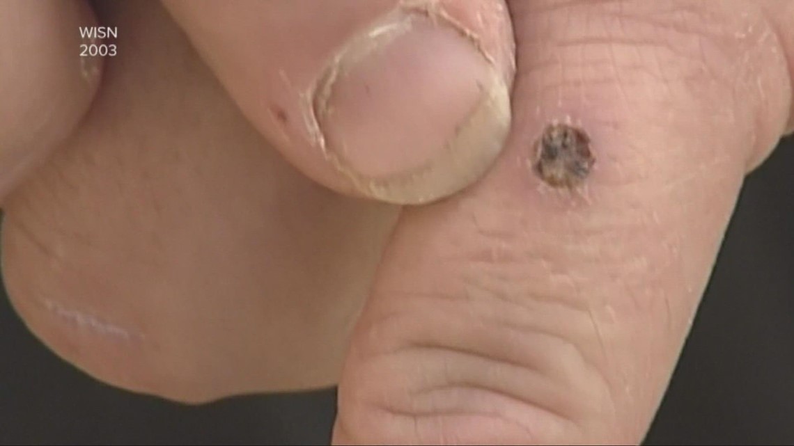 Third possible case of monkeypox in Sacramento County identified