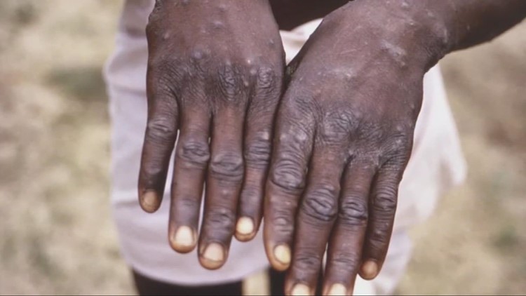 Possible Monkeypox case identified in Sacramento County, person isolating | Top 10
