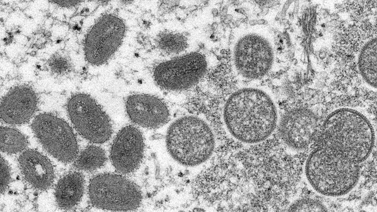 Second suspected Monkeypox case being investigated in Sacramento