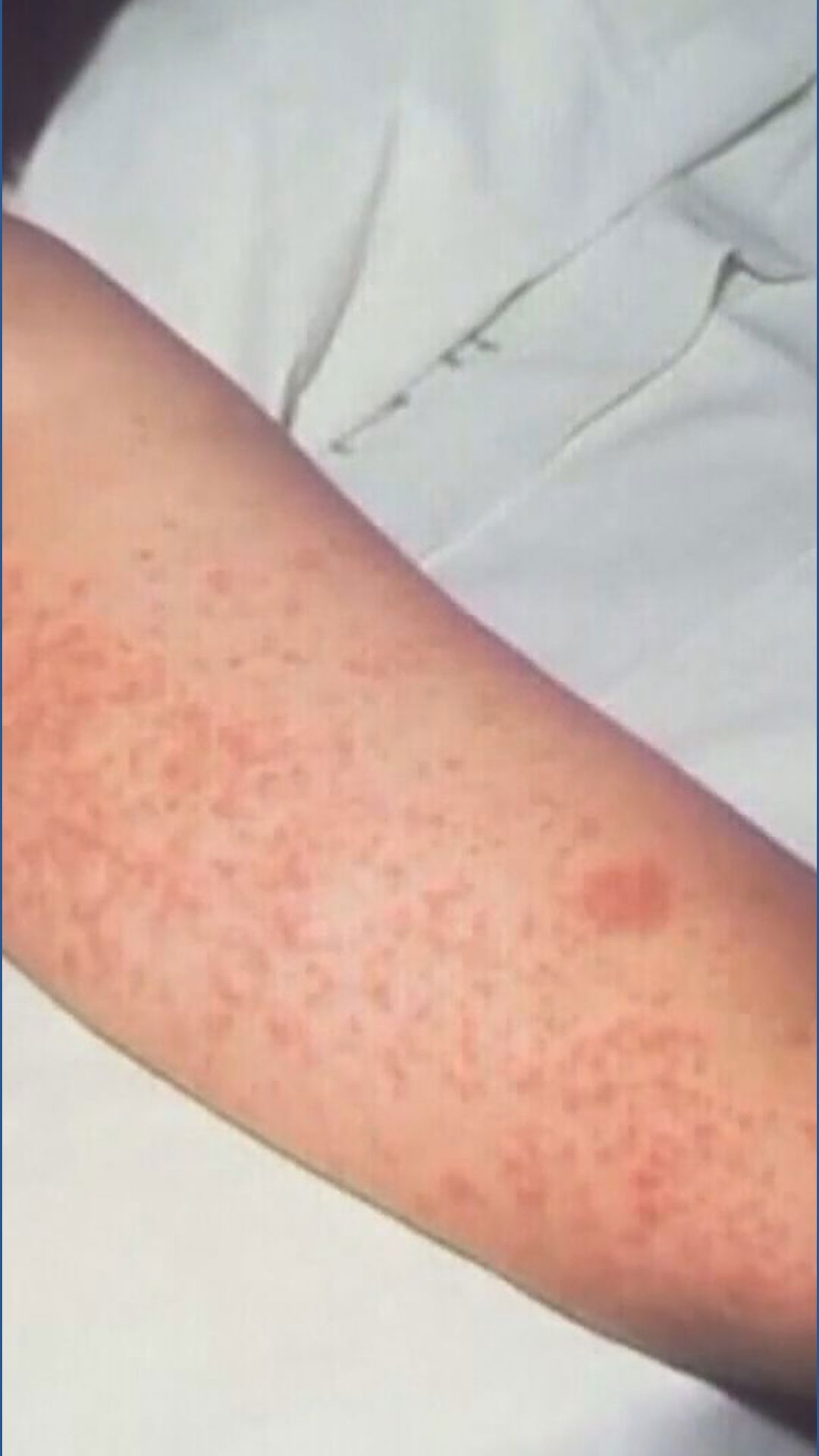 'We're concerned about continued spread': Measles outbreak grows across Placer, Sacramento counties
