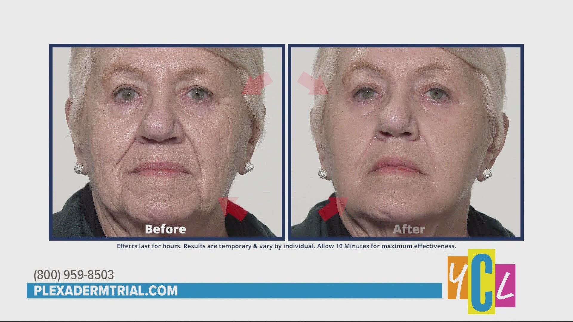 Plexaderm can help reduce the appearance of under eye bags, dark circles and wrinkles. This is a paid segment for True Earth Health Solutions.