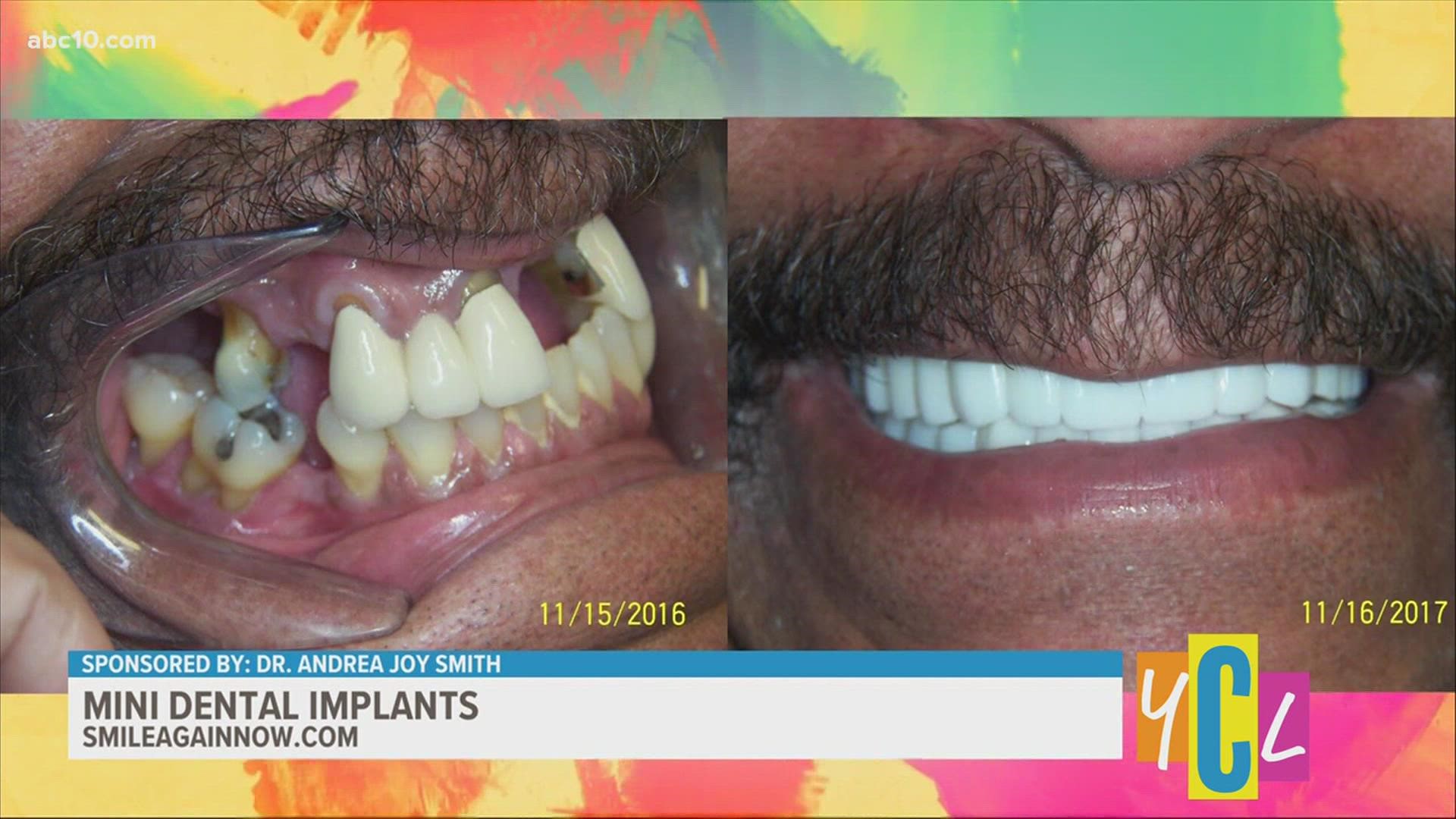 If smiling has you frowning due to missing teeth, consider trying mini dental implants. This segment paid for by Dr. Andrea Joy Smith.